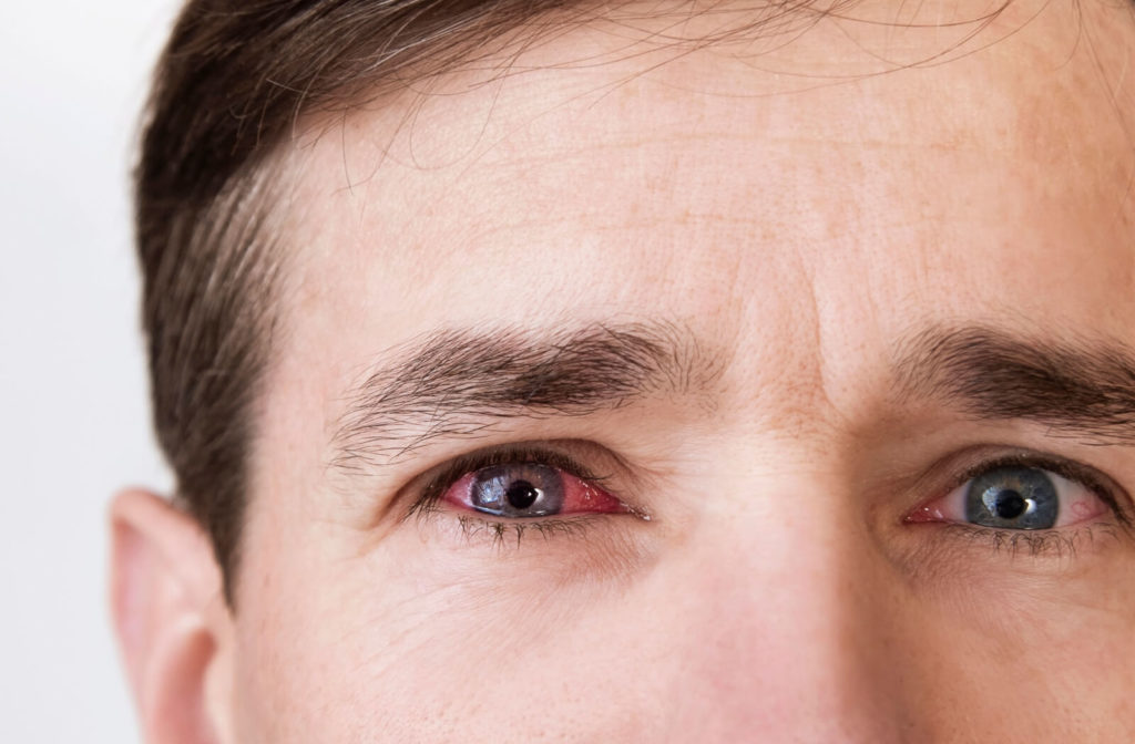 A close-up of a man's eyes. The right eye showing signs of inflammation.