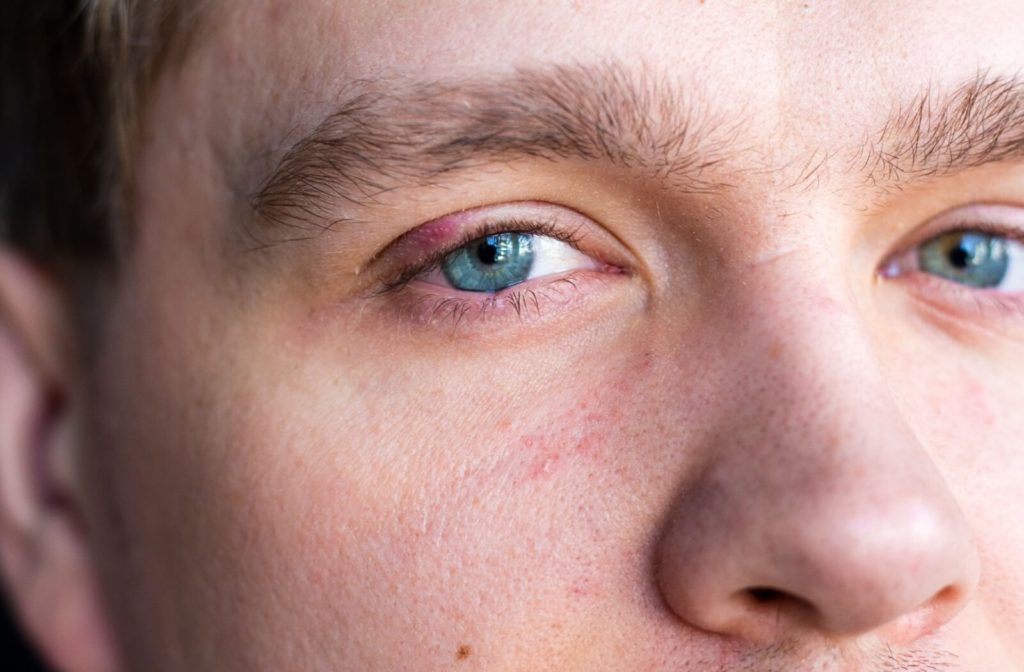 A close-up picture of an uncomfortable looking stye on an eyelid.