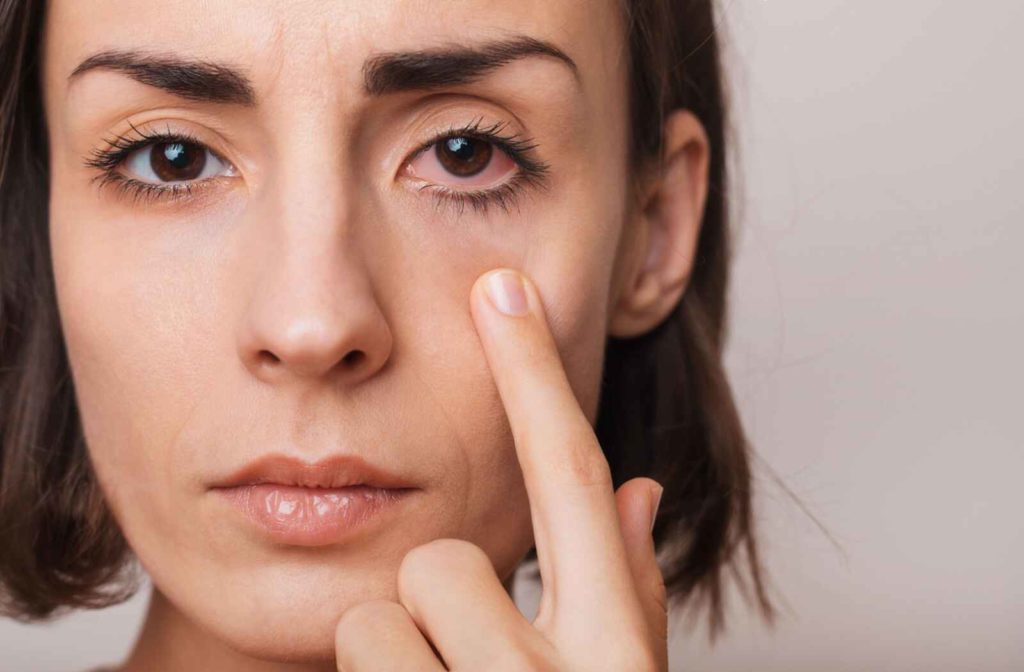 A young woman gently pulls down on her face, exposing her pink eye.