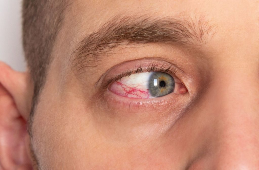 A close-up image of a man's irritated, bloodshot eye from untreated dry eye.