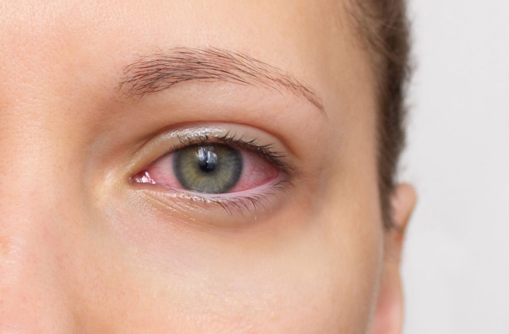 A close up of a woman's red, dry eye.